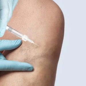 Sclerotherapy